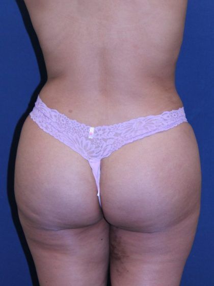 Brazilian Butt Lift Before & After
