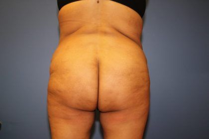 Brazilian Butt Lift Before & After