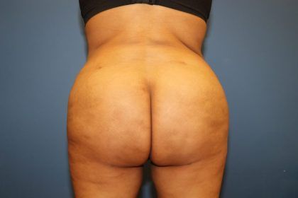 Brazilian Butt Lift Before & After