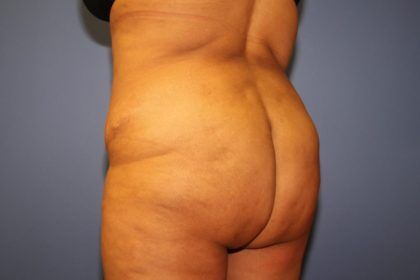 Brazilian Butt Lift Before & After