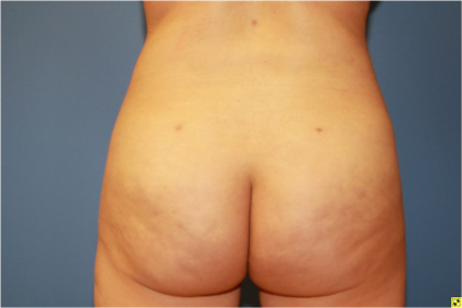 Brazilian Butt Lift Before & After