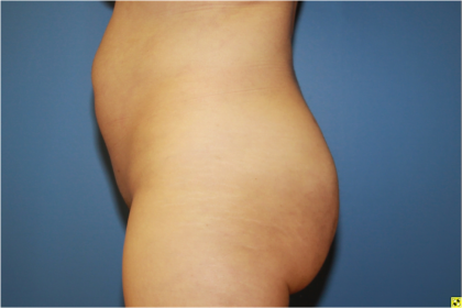 Brazilian Butt Lift Before & After