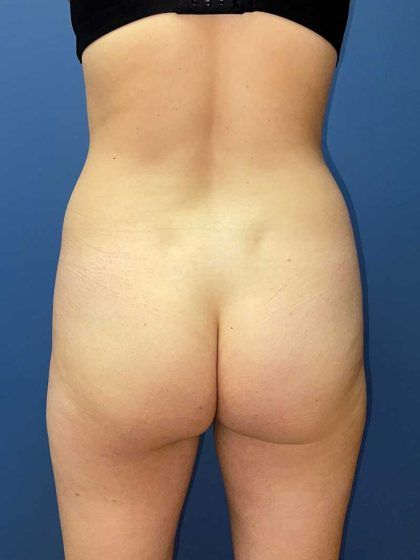 Brazilian Butt Lift Before & After