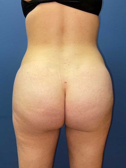 Brazilian Butt Lift Before & After