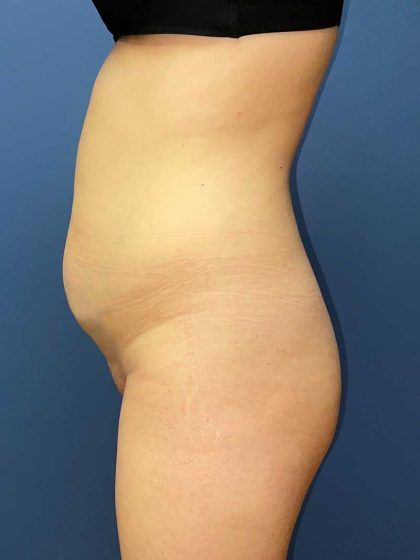 Brazilian Butt Lift Before & After