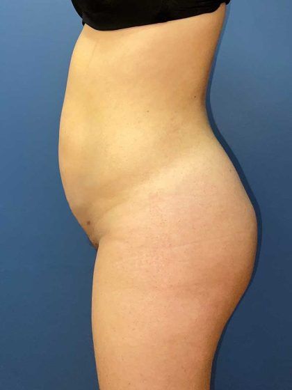 Brazilian Butt Lift Before & After