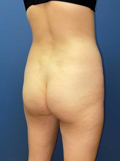 Brazilian Butt Lift Before & After