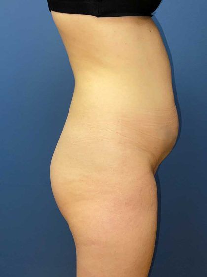 Brazilian Butt Lift Before & After