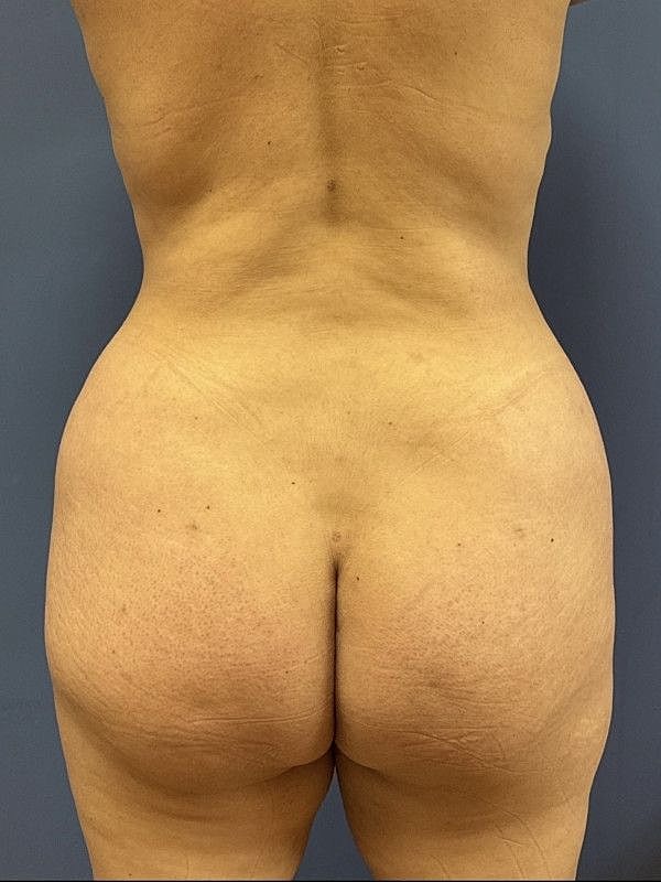 Brazilian Butt Lift Before & After