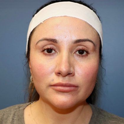 Buccal Fat Before & After