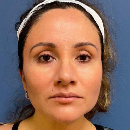 Buccal Fat Before & After