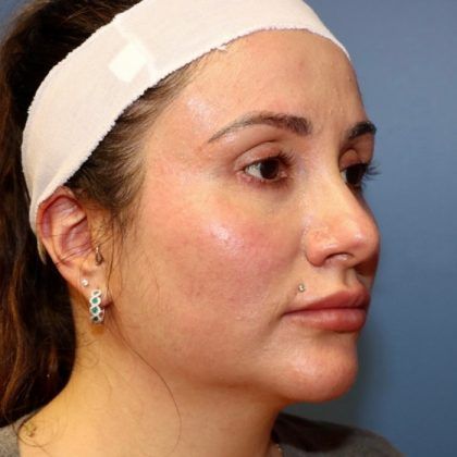 Buccal Fat Before & After