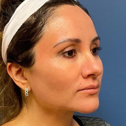 Buccal Fat Before & After