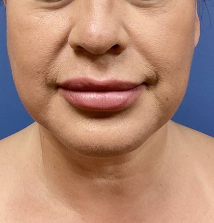 Buccal Fat Before & After