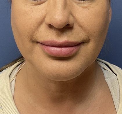 Buccal Fat Before & After