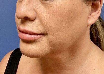 Buccal Fat Before & After