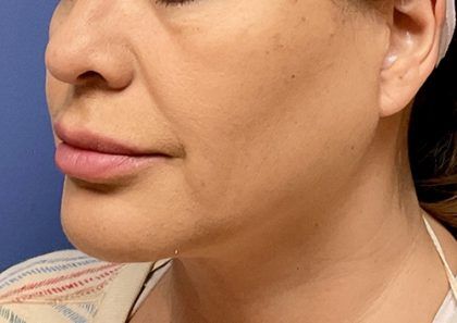 Buccal Fat Before & After