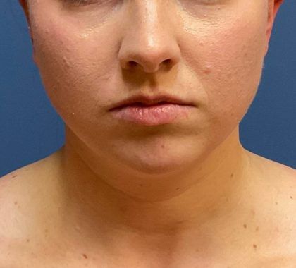 Buccal Fat Before & After