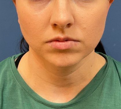 Buccal Fat Before & After