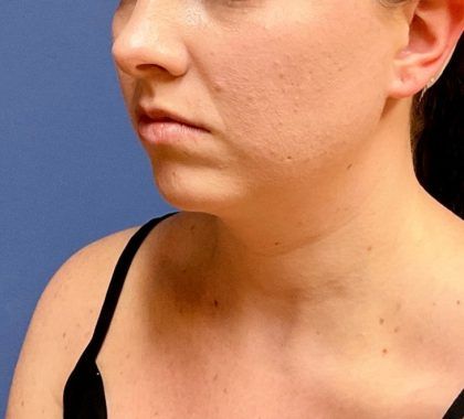 Buccal Fat Before & After