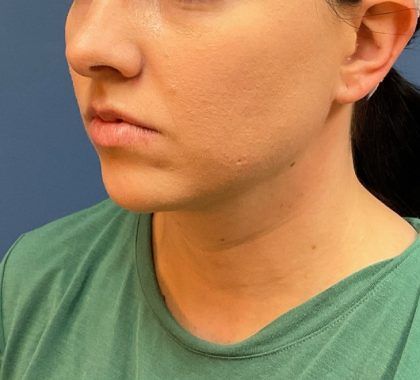 Buccal Fat Before & After