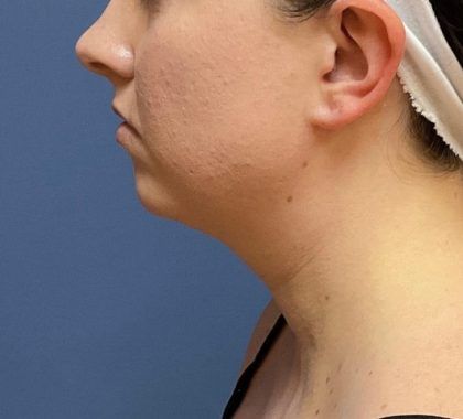 Buccal Fat Before & After