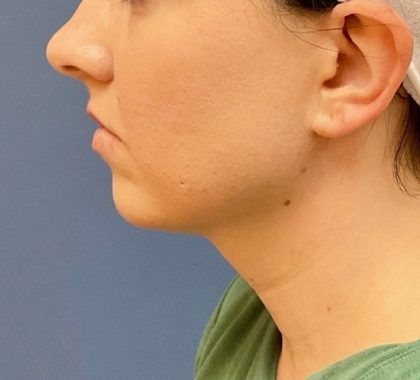 Buccal Fat Before & After