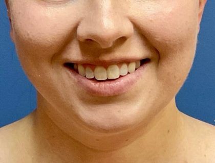 Buccal Fat Before & After