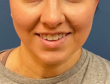 Buccal Fat Before & After
