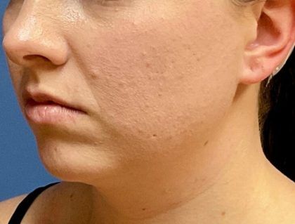 Buccal Fat Before & After