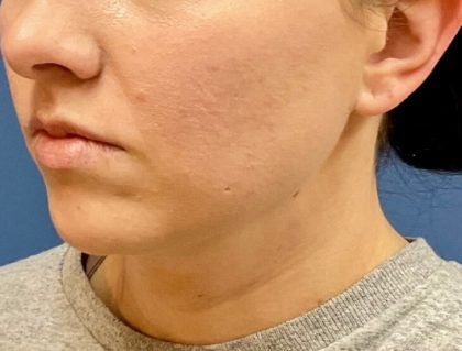 Buccal Fat Before & After