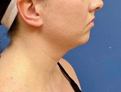 Buccal Fat Before & After