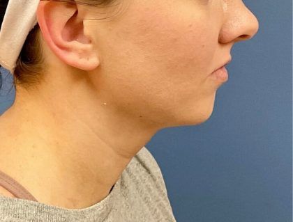 Buccal Fat Before & After