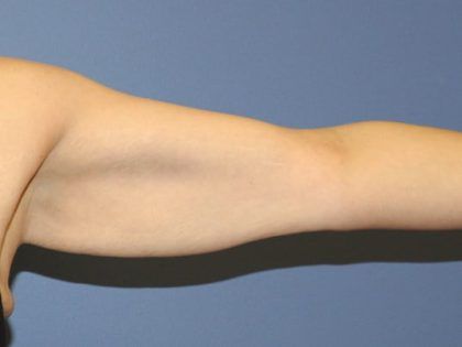 Arm Lift Before & After