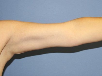 Arm Lift Before & After