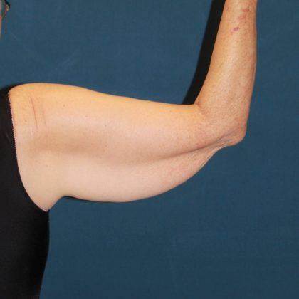 Arm Lift Before & After