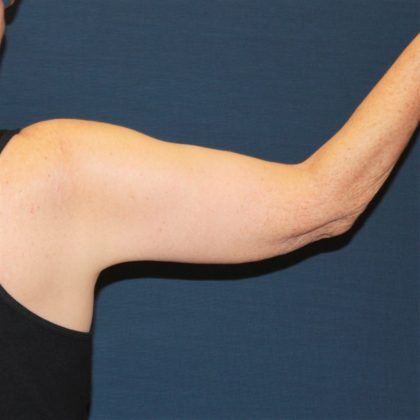 Arm Lift Before & After