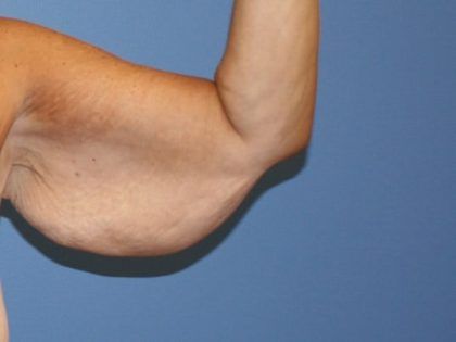 Arm Lift Before & After