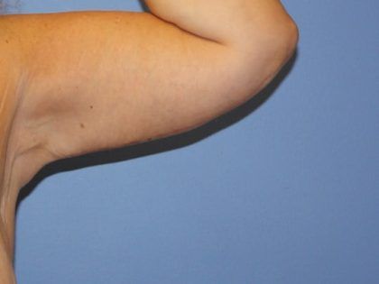 Arm Lift Before & After