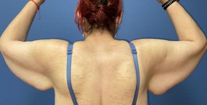 Arm Lift Before & After