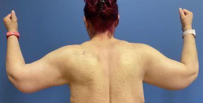 Arm Lift Before & After