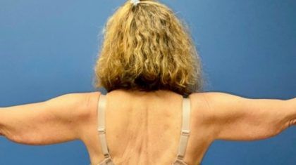 Arm Lift Before & After