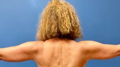 Arm Lift Before & After