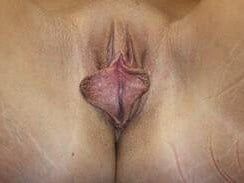 Clitoral Hood Reduction Before & After