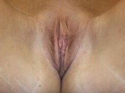 Clitoral Hood Reduction Before & After