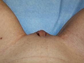 Clitoral Hood Reduction Before & After