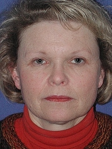 Brow Lift Before & After