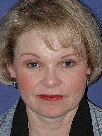 Brow Lift Before & After