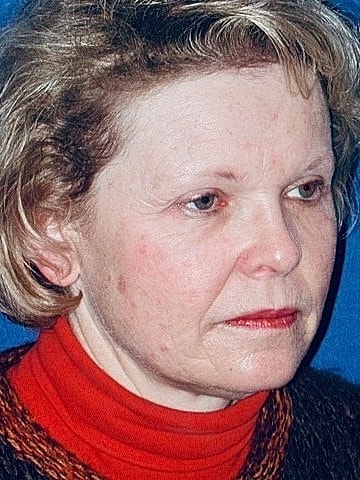 Brow Lift Before & After