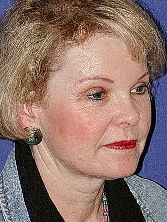 Brow Lift Before & After